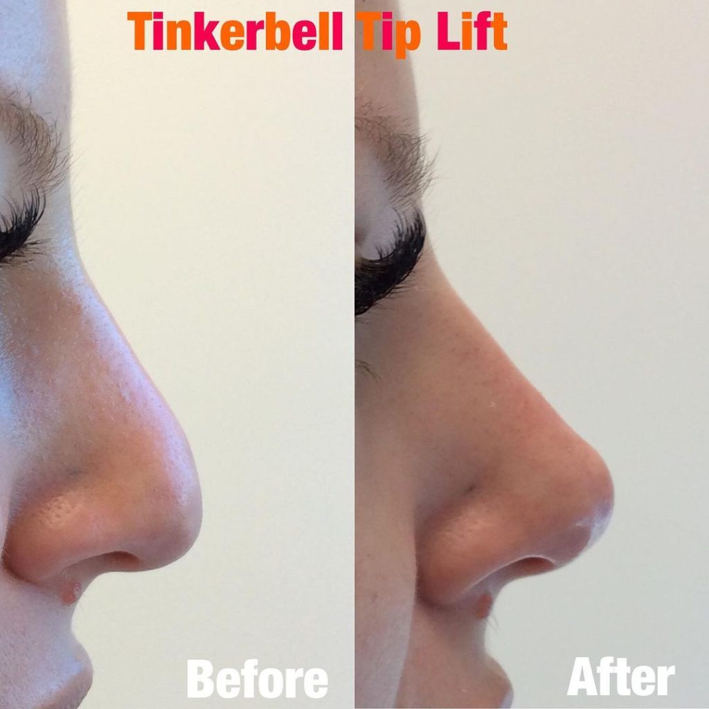 Tinkerbell Tip Lift